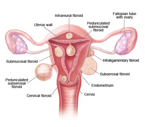 Detailed diagram of female reproductive organs showing fibroids and uterus structure.