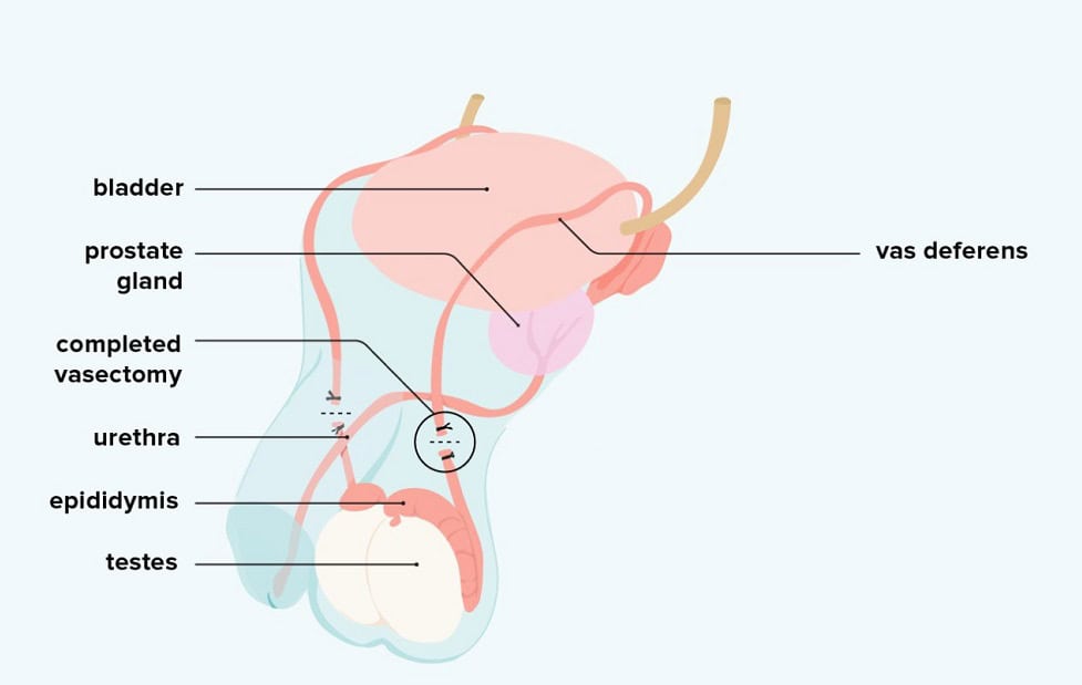 Vasectomy