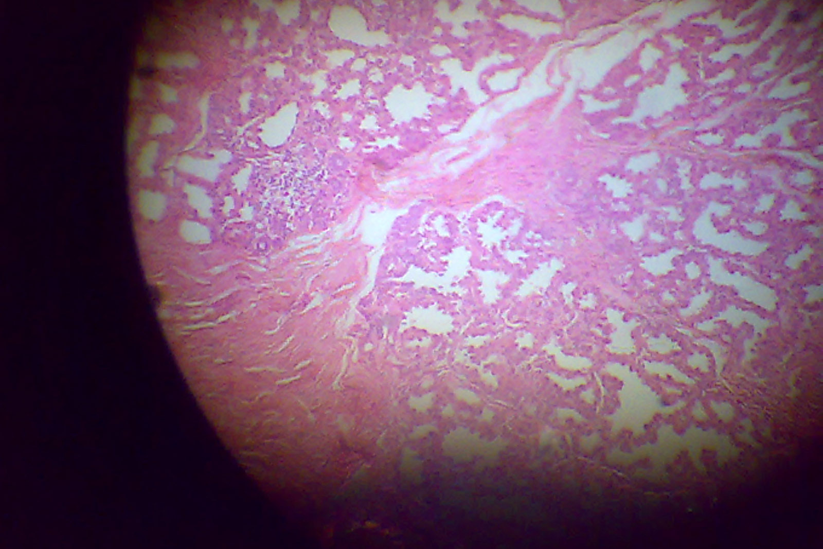 Noninvasive treatment for breast ductal carcinoma effective in mice