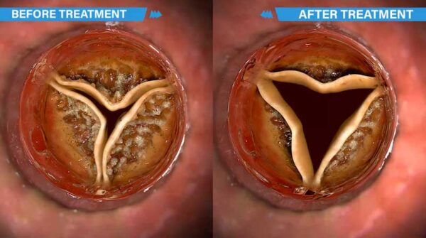 An aortic valve before and after use of a non-invasive heart valve therapy