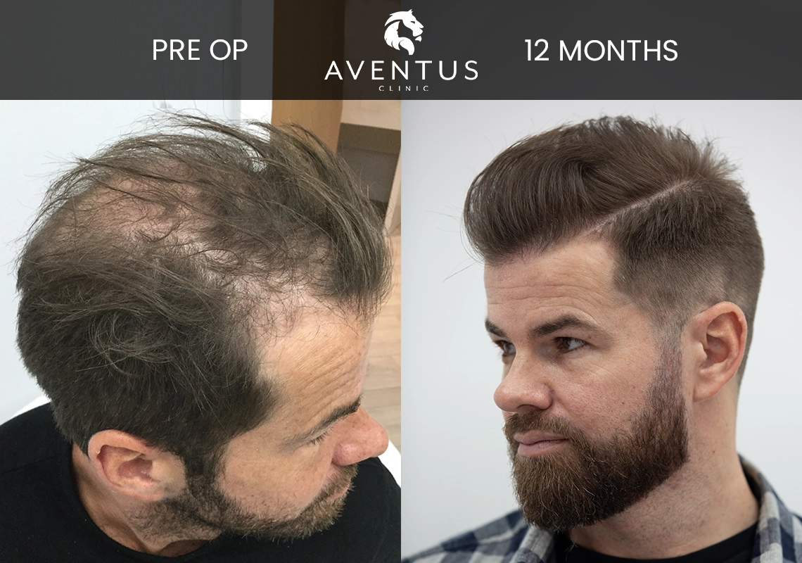 Owen-After-12-Months
