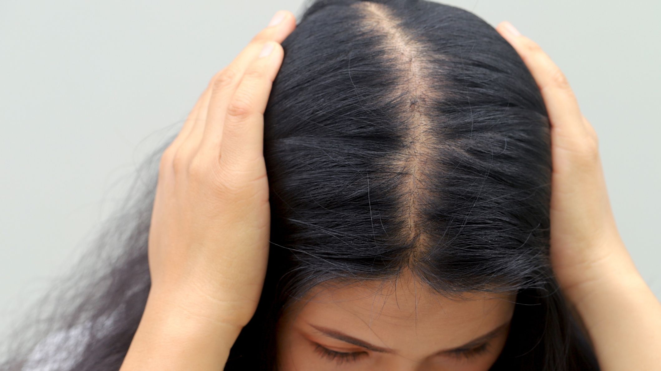 Women with Hair Loss and Dry hair