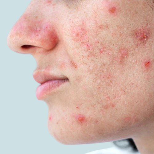 acne