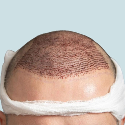 fue-hair-transplant