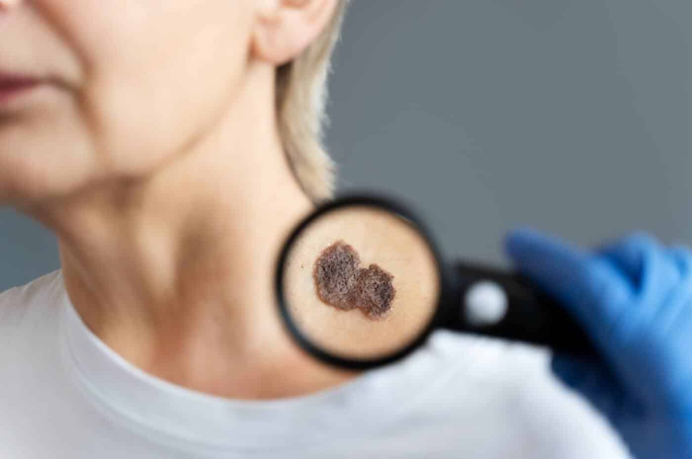 skin cancer checks