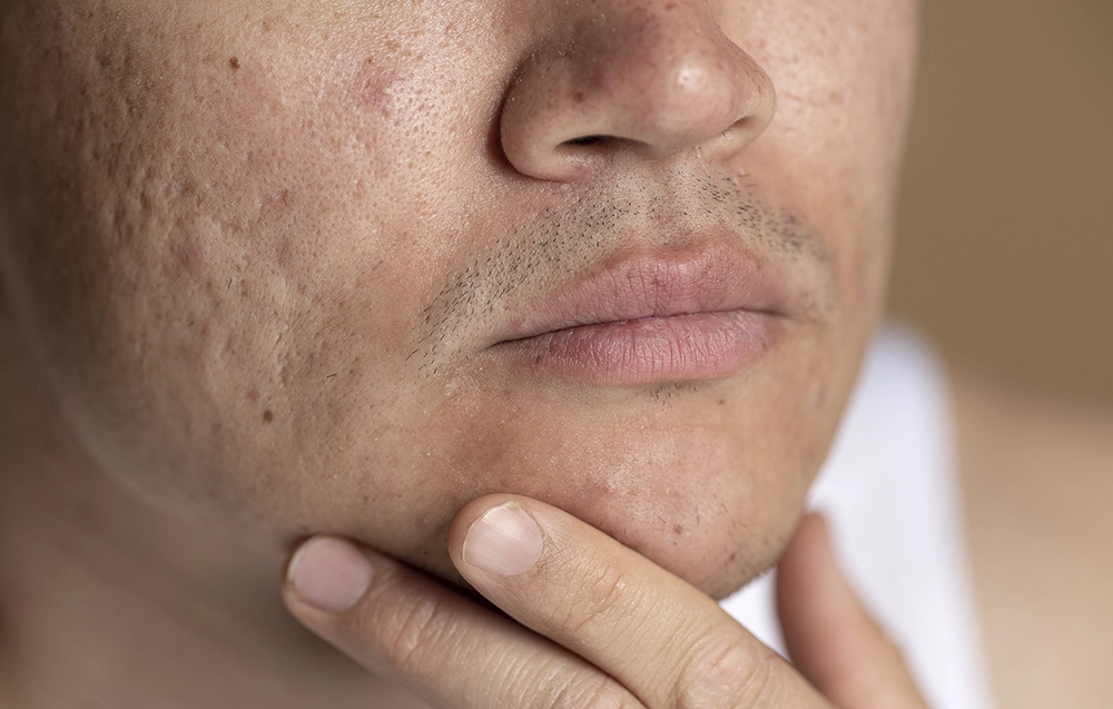 Acne Scars