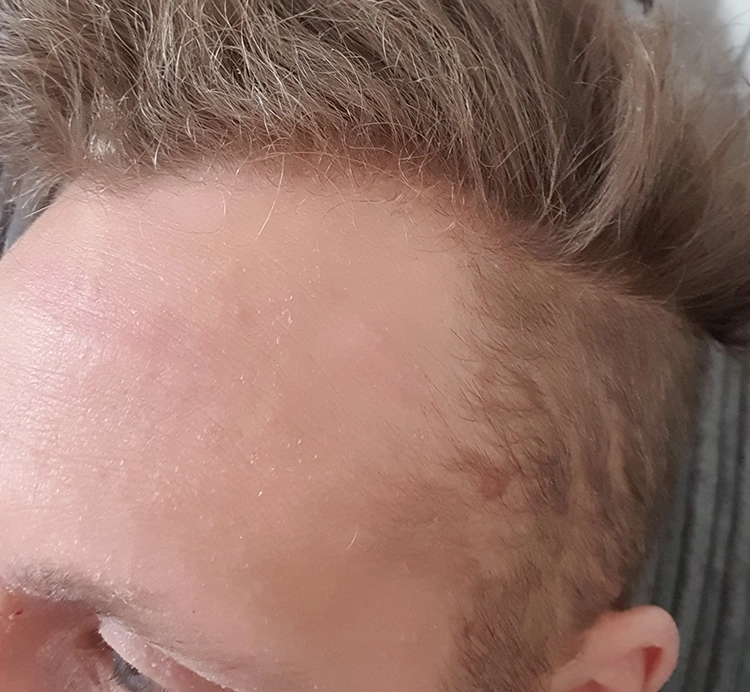 Cyst after removal