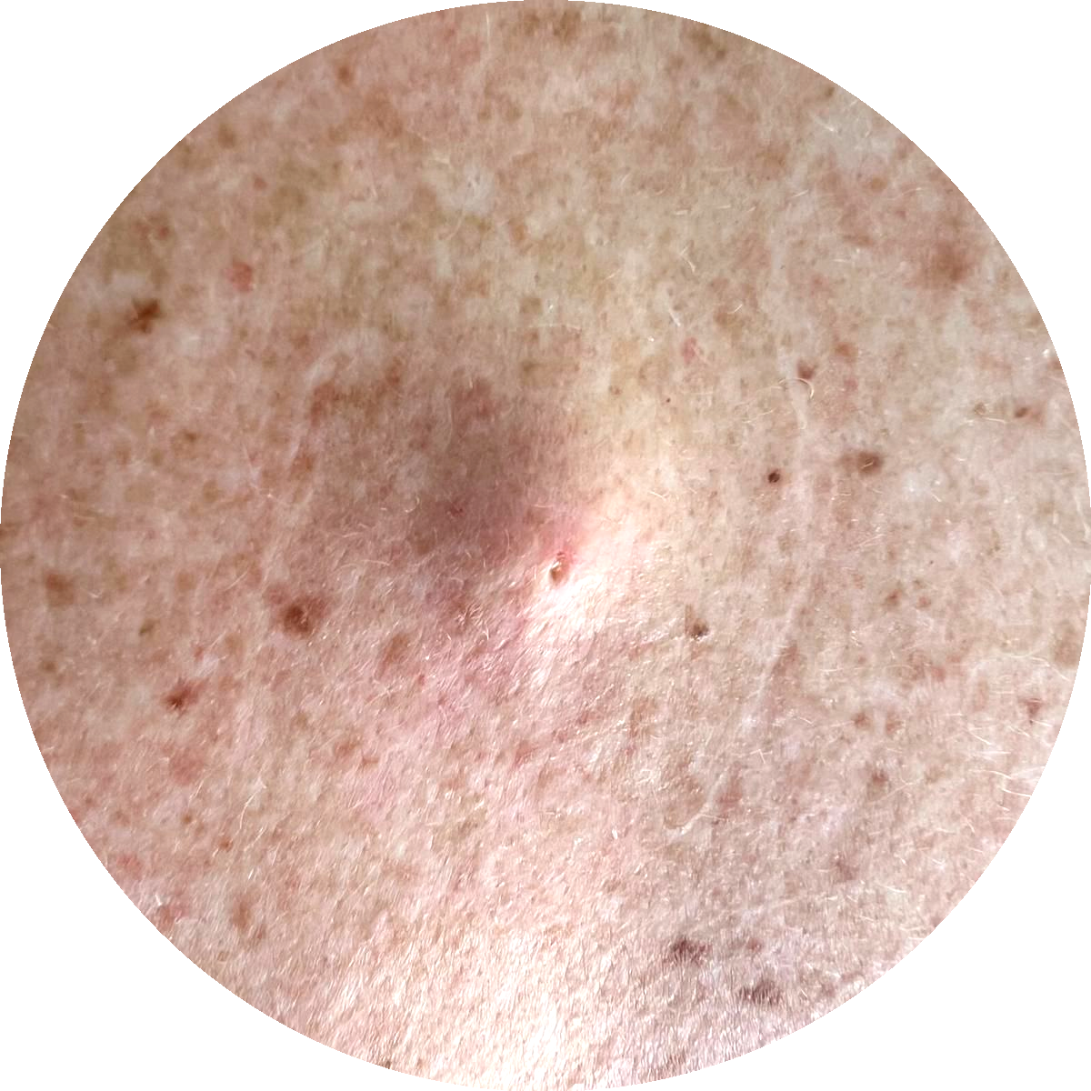 Epidermoid cyst example