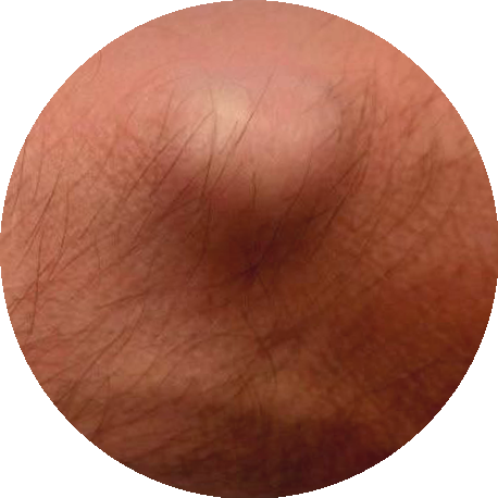 Ganglion cyst example