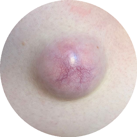 Lump example