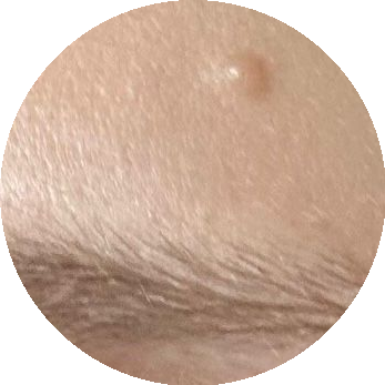 Milia cyst example