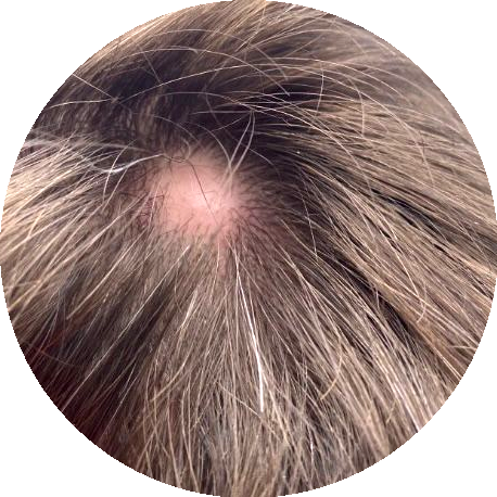 Pliar cyst example