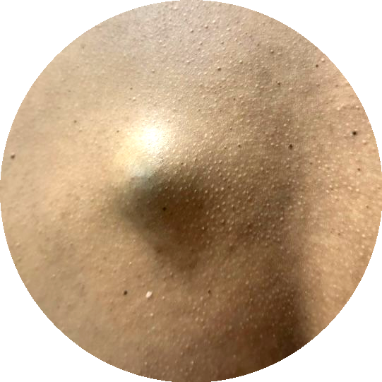 Sebaceous cyst example