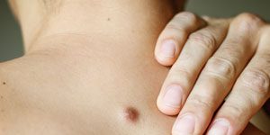 Cyst-Removal
