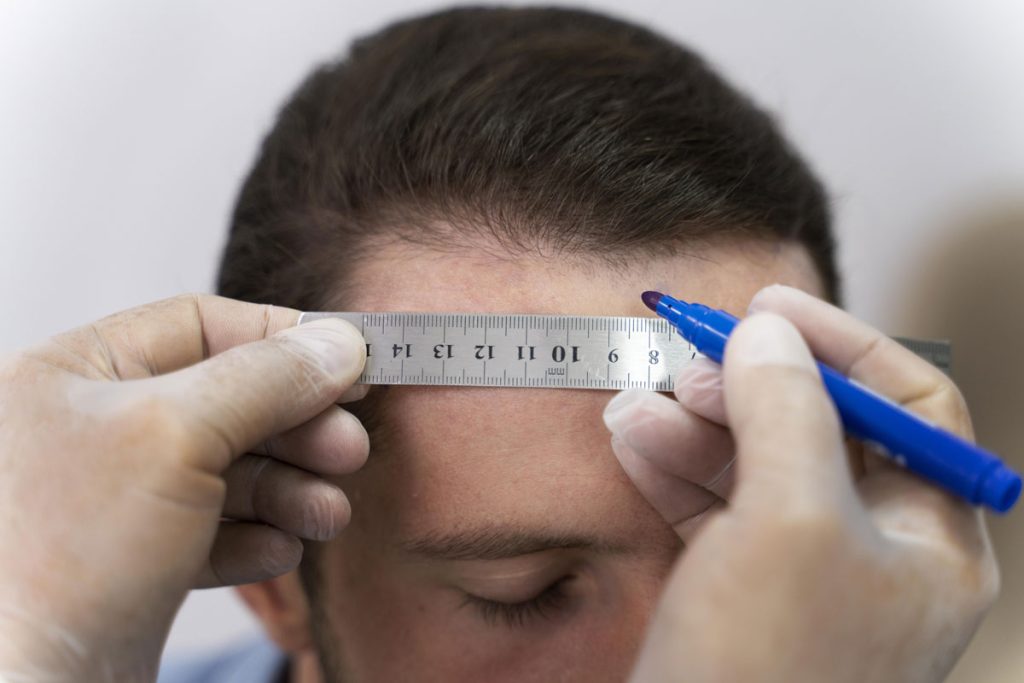 During hair transplant graft calculator