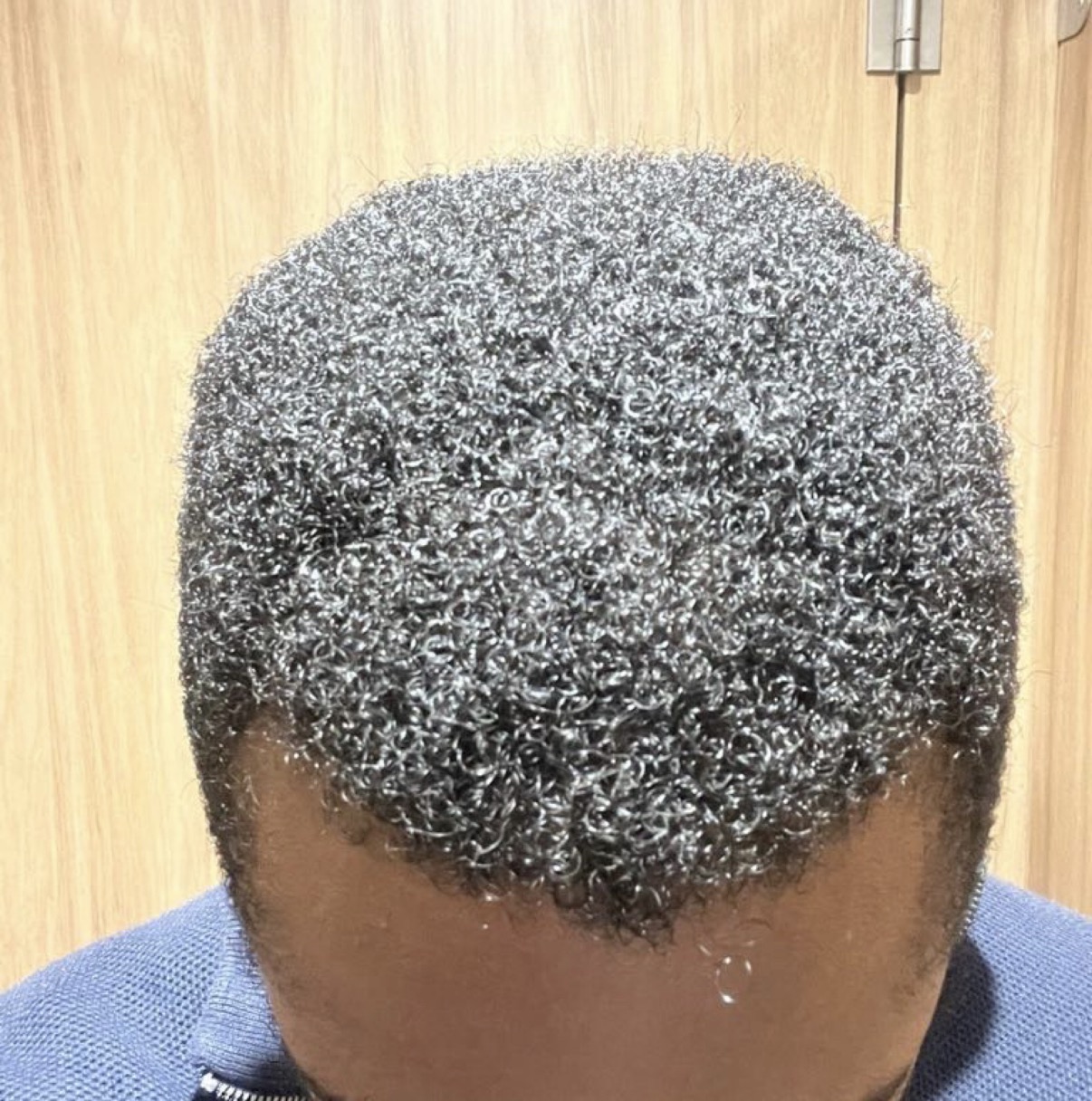 after non surgical hair treatment