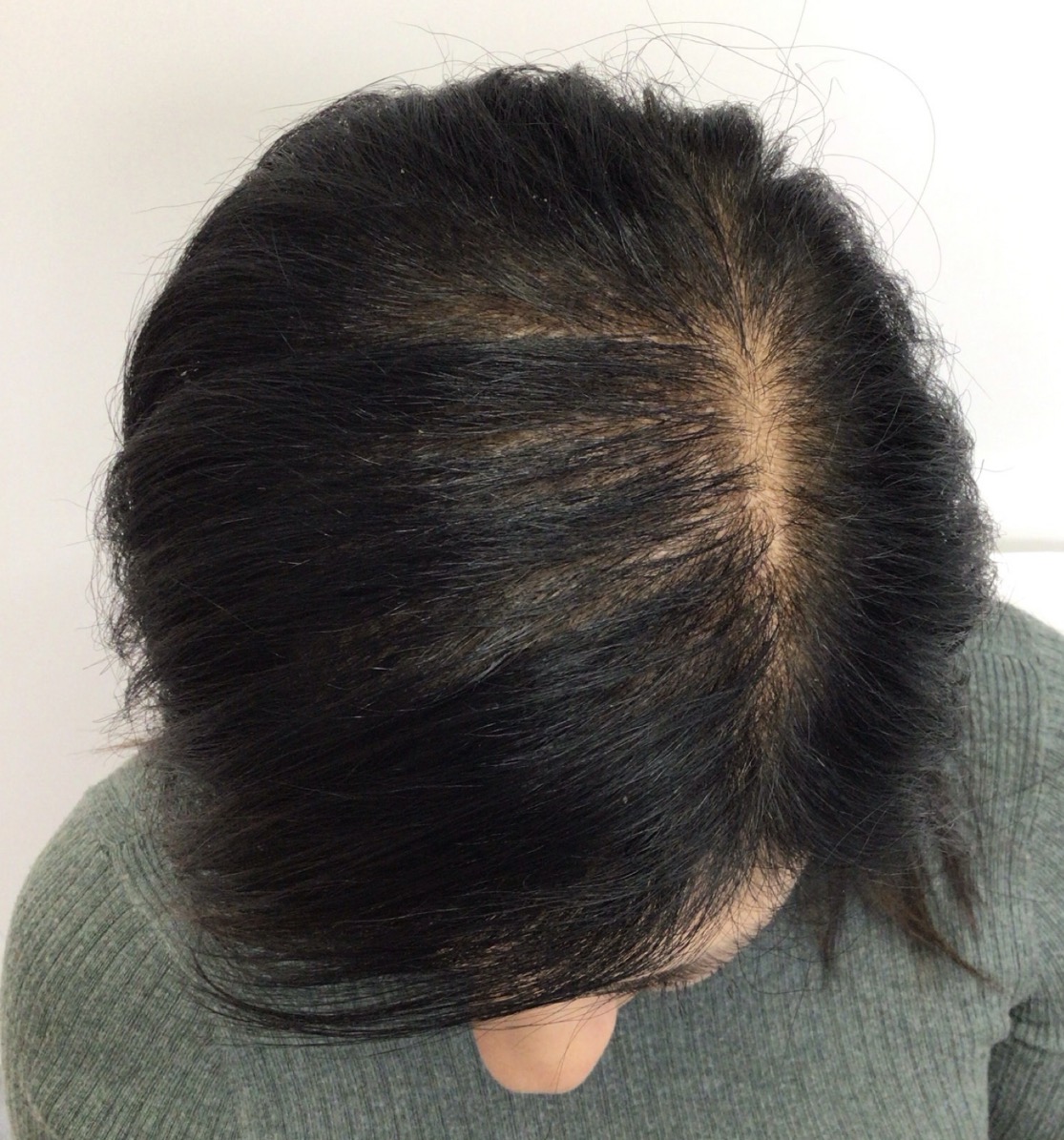 after non surgical hair treatment