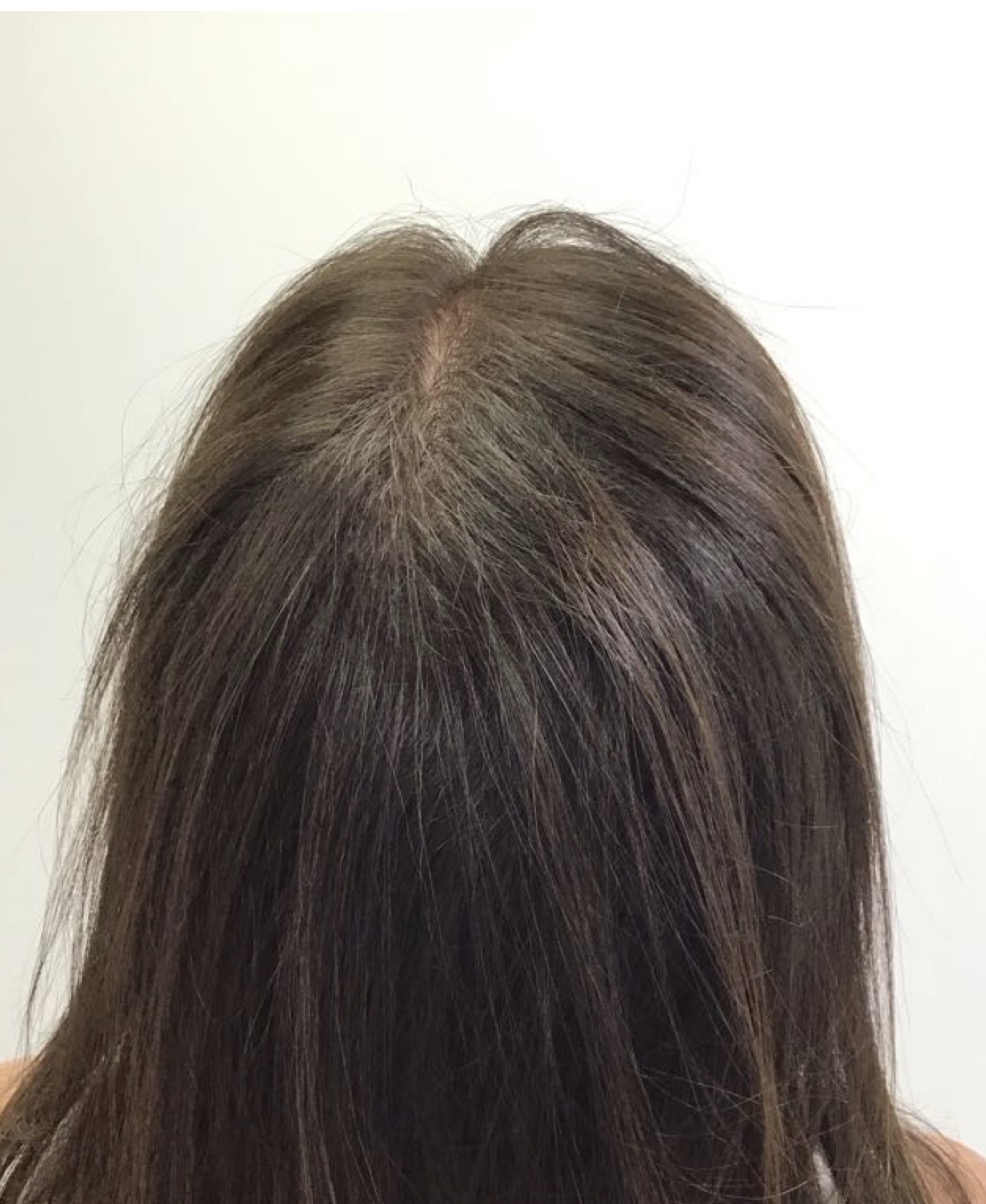 after non surgical hair treatment