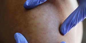 Lipoma check up