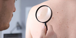 Mole-Check