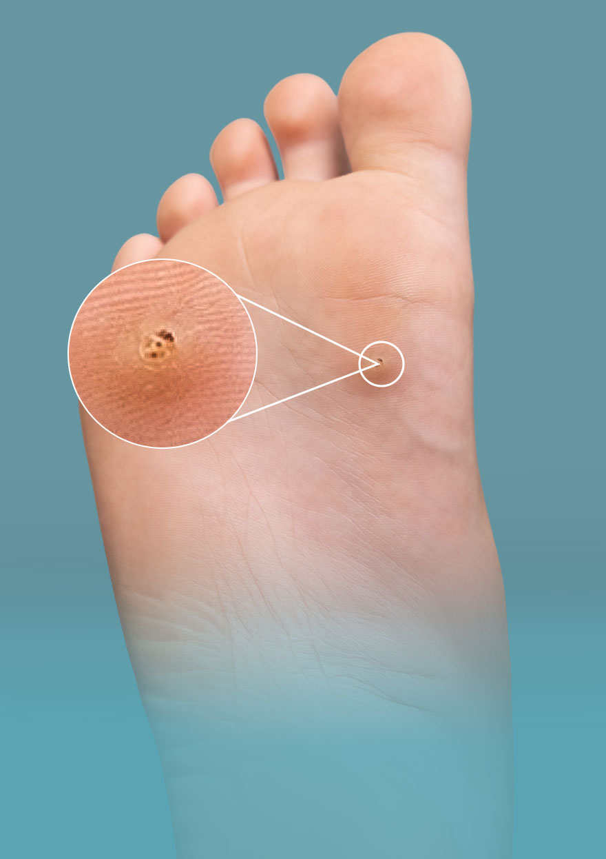 Warts-and-Verrucas-Removal