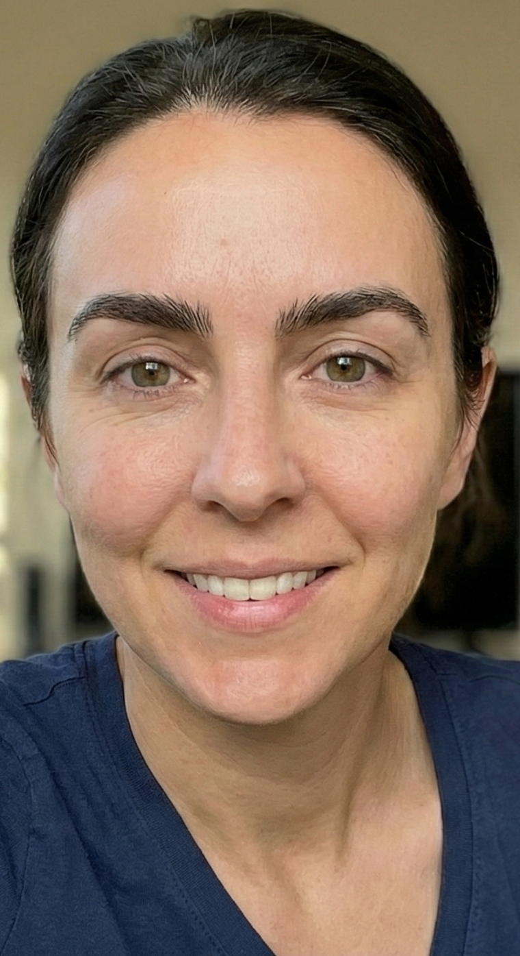 after eyebrow transplant