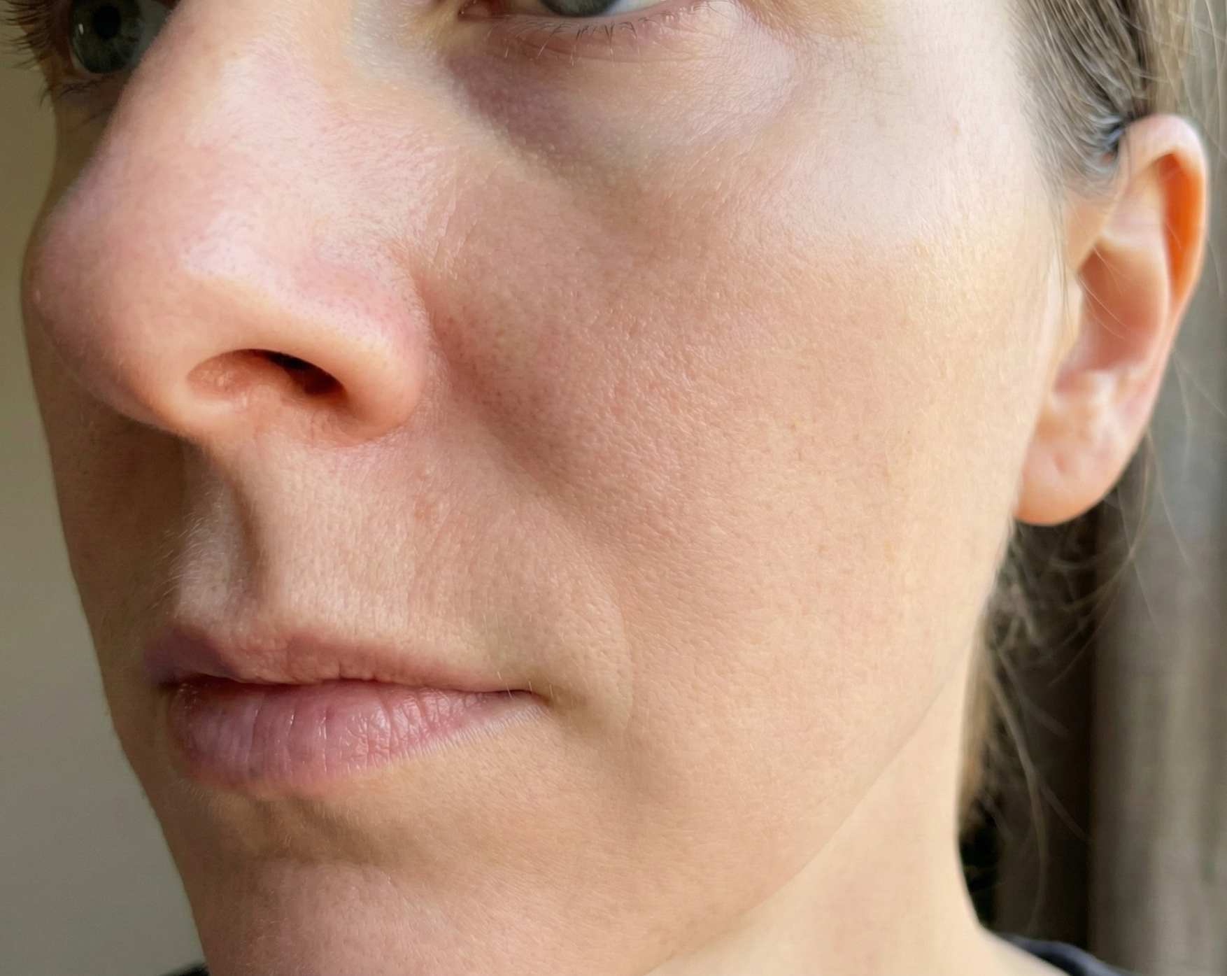 after facial veins