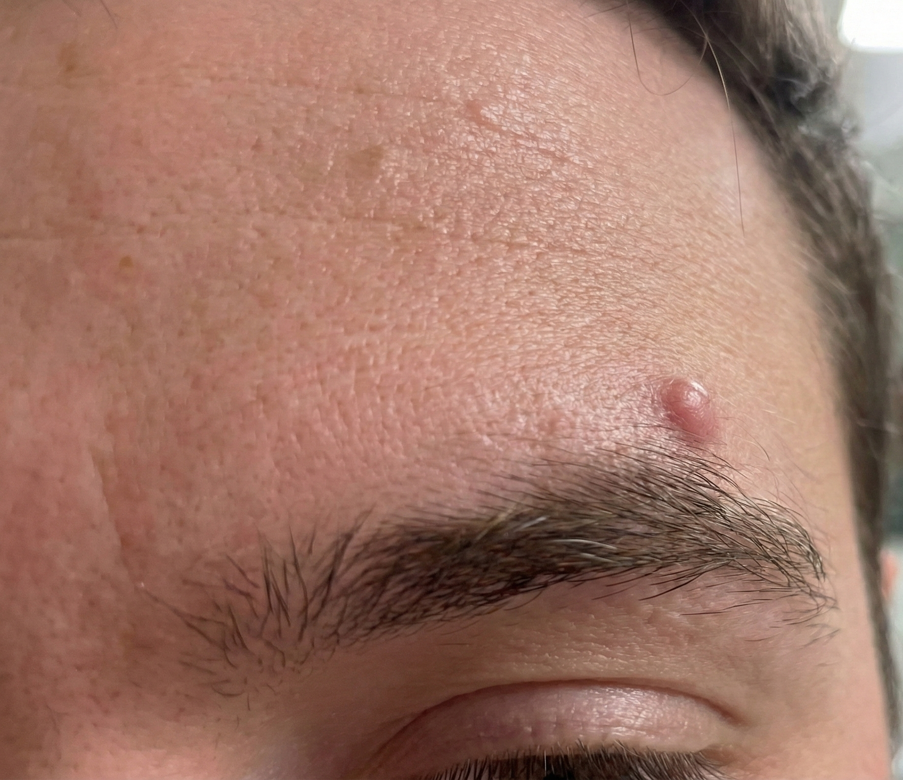 before image eyebrow cyst