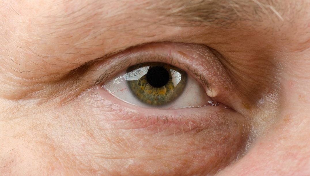 eyelid cysts