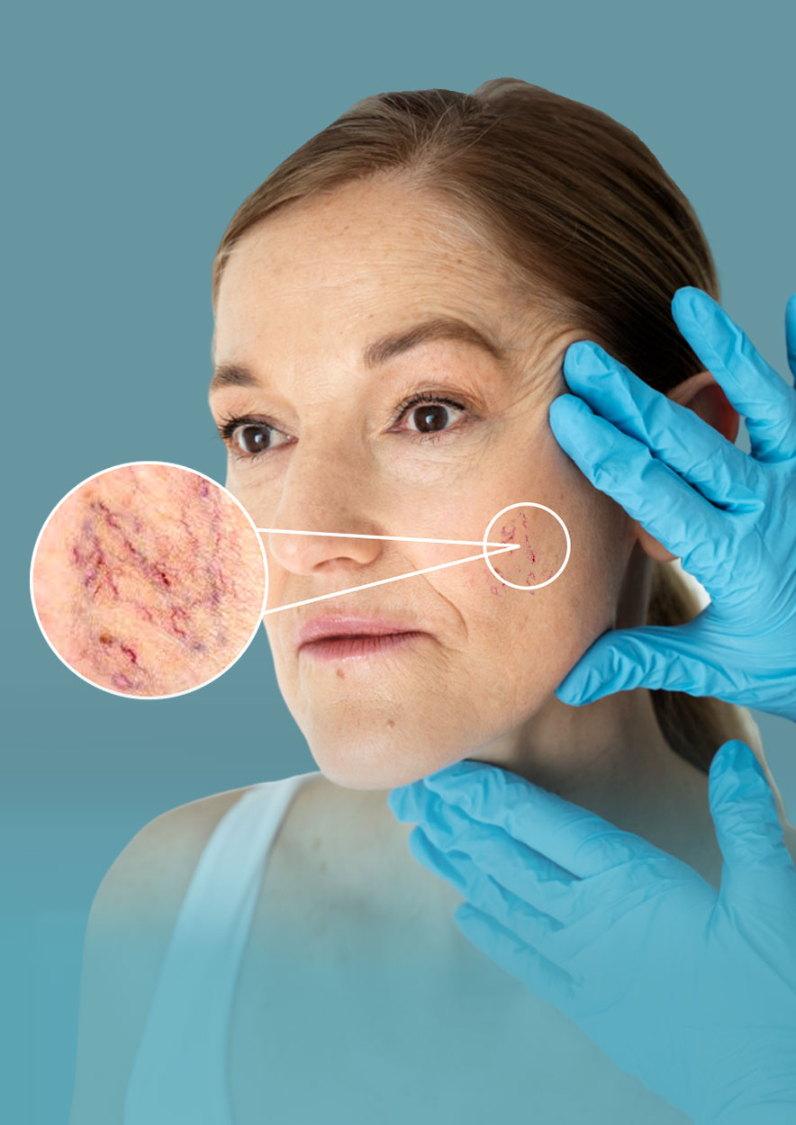 facial-veins-removal