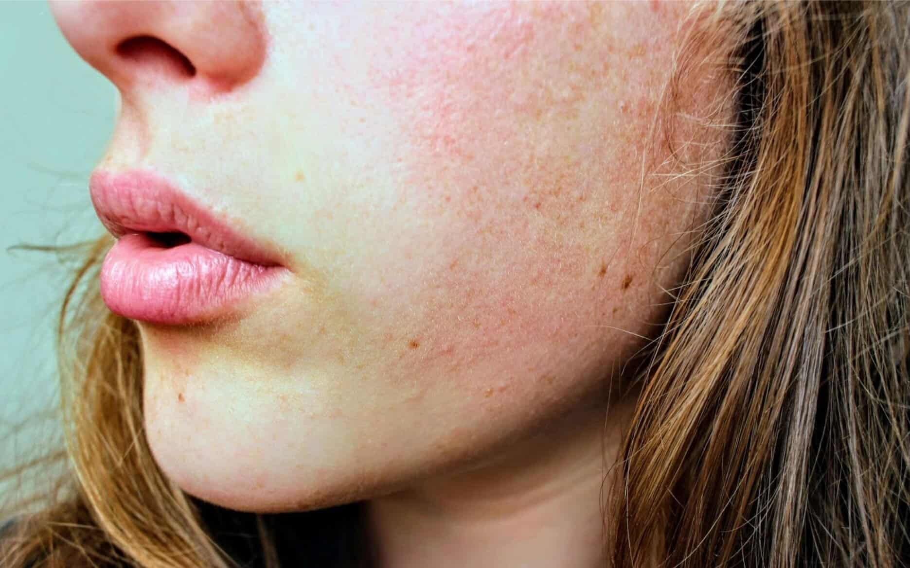 scaly patches on face