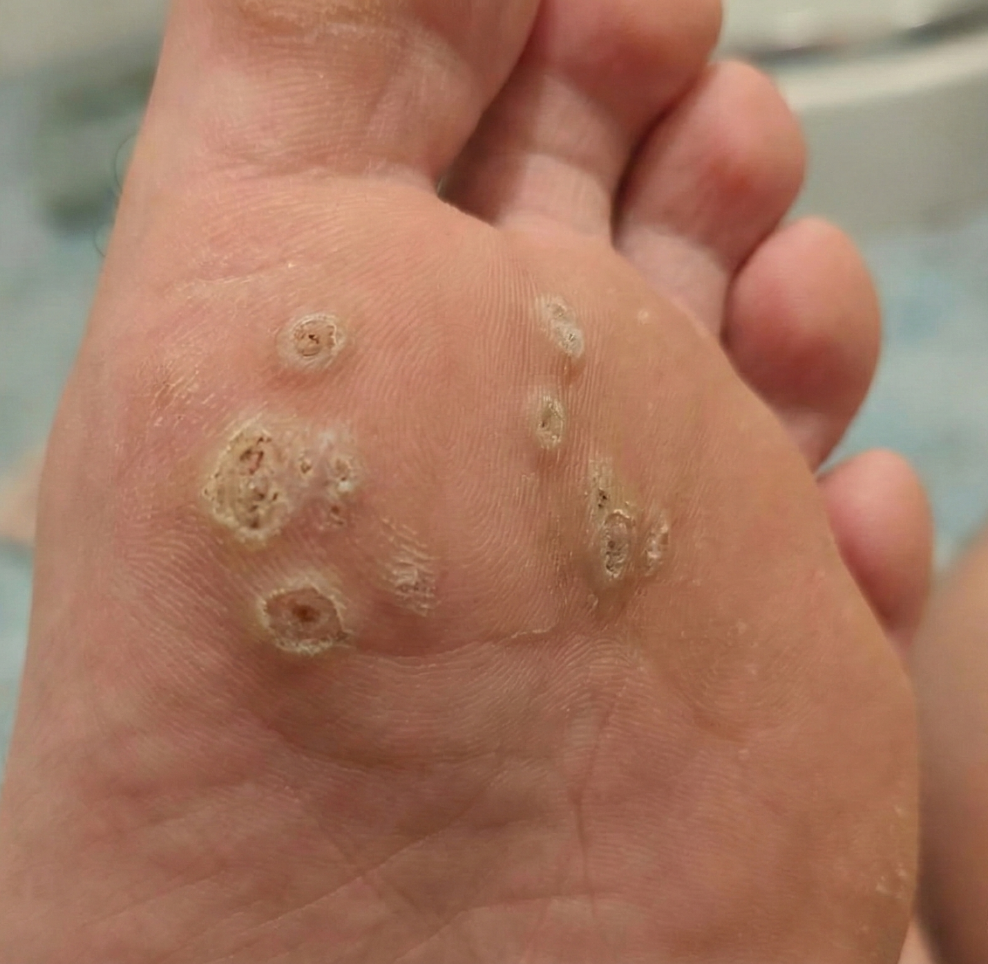 warts before
