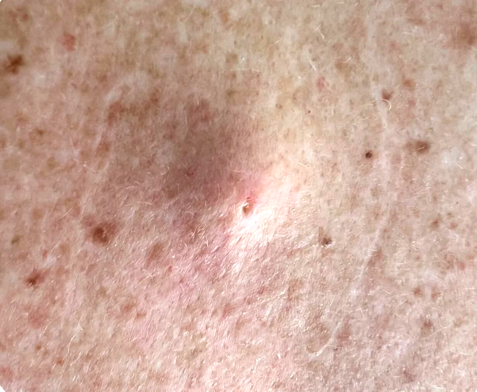 Epidermoid
