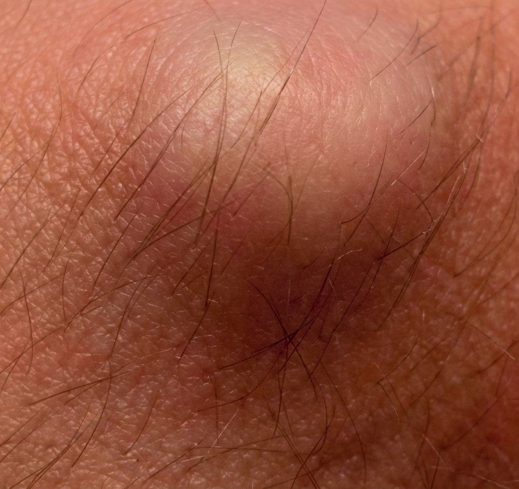 Ganglion Cyst