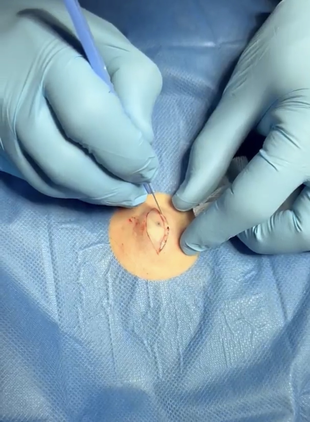 Cyst removal procedure