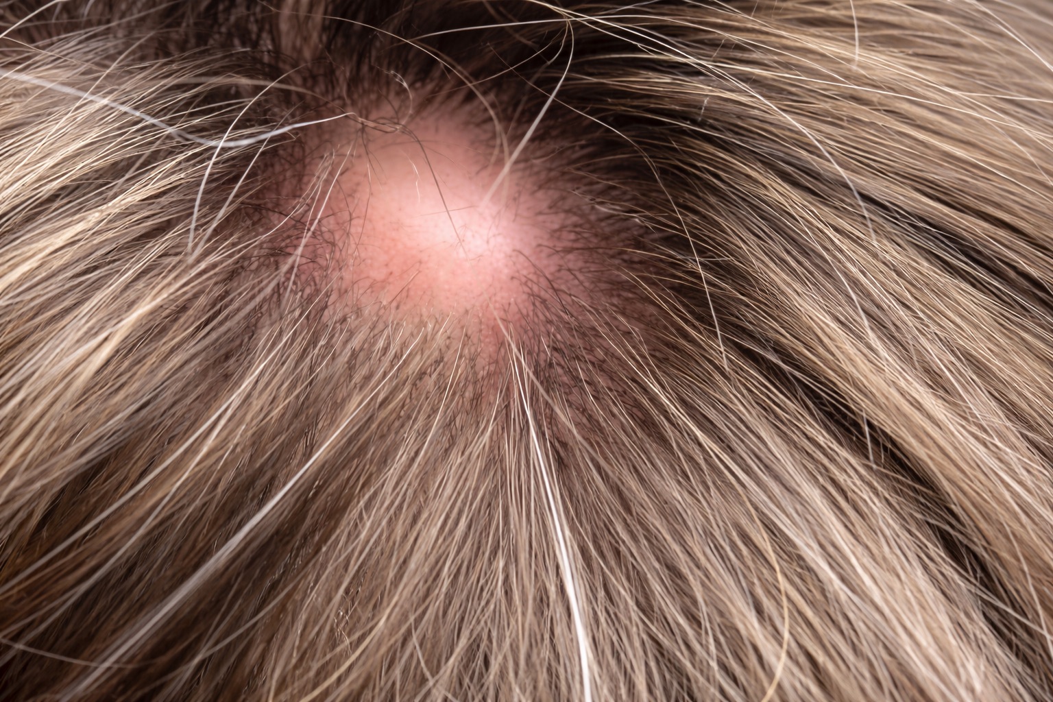 Pilar Cysts