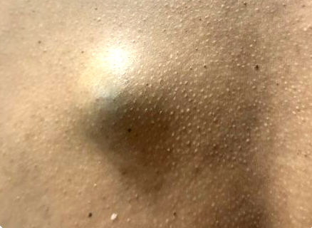 Sebaceous