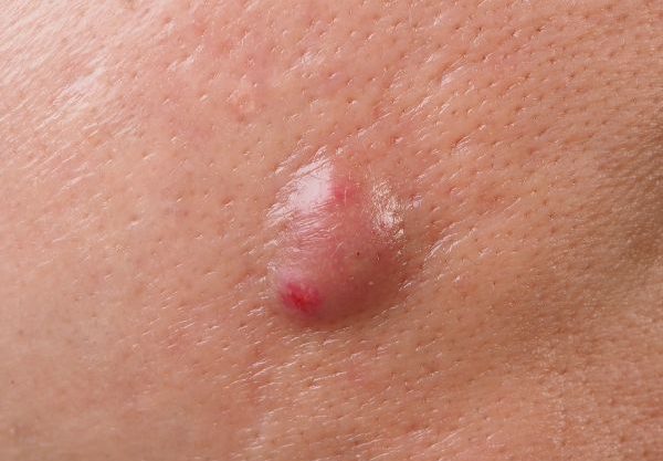 Big Acne Cyst Abscess in the face