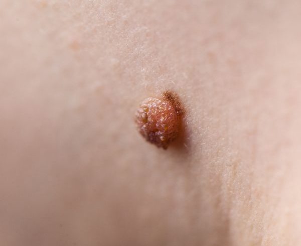 dark fibroma on skin