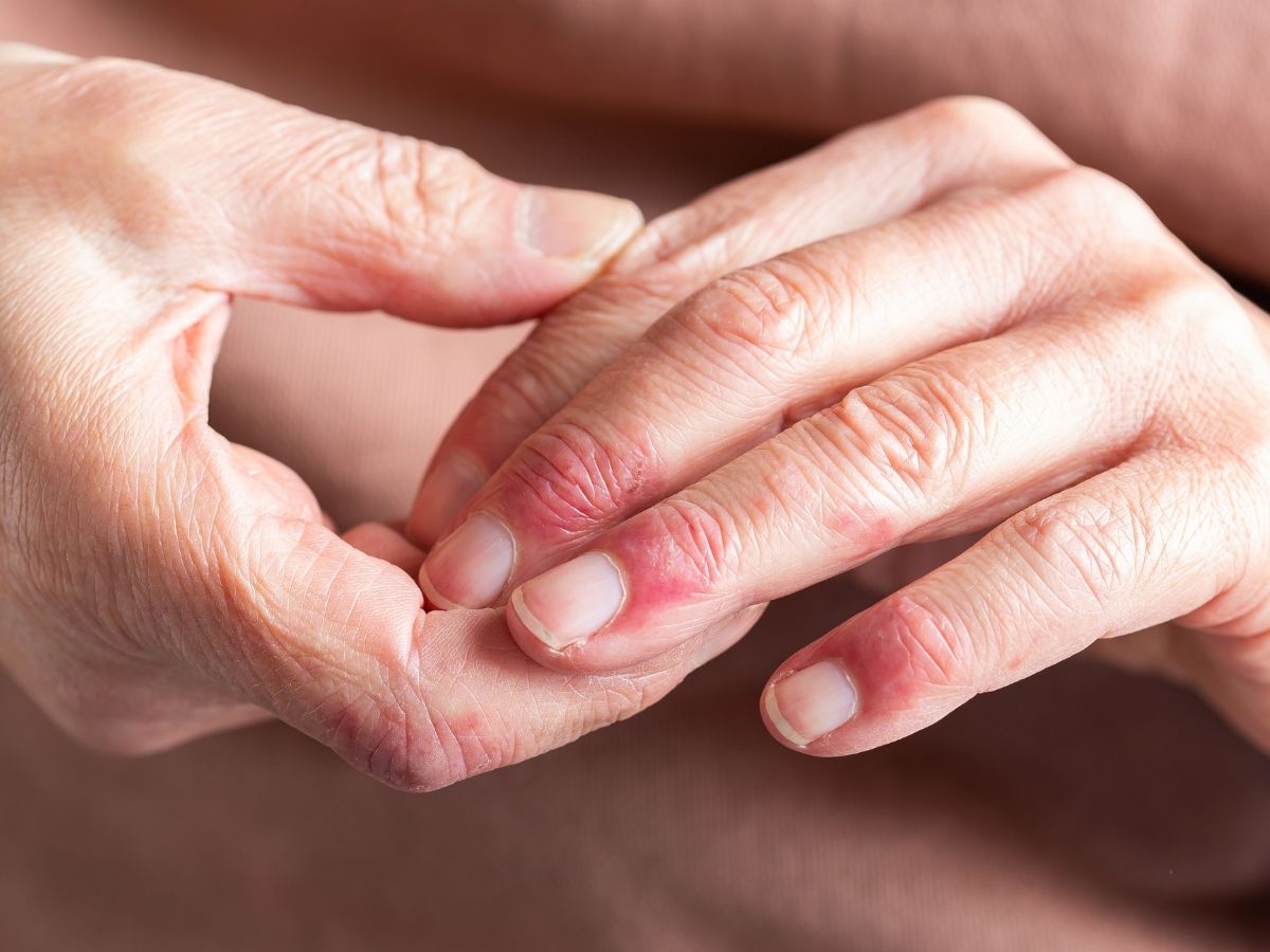 Eczema flare ups