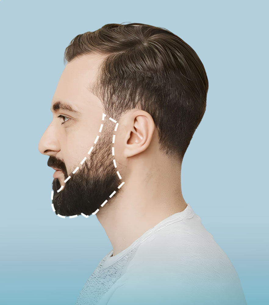 FUE Beard Transplant