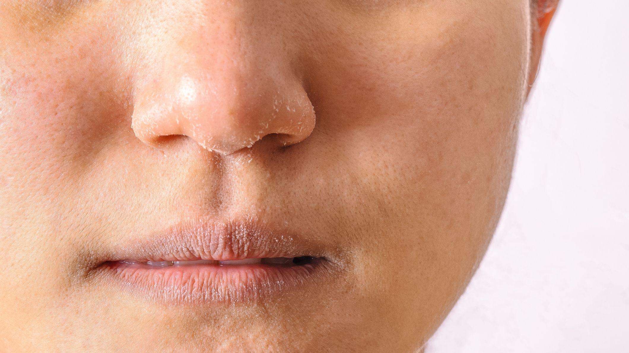 face eczema