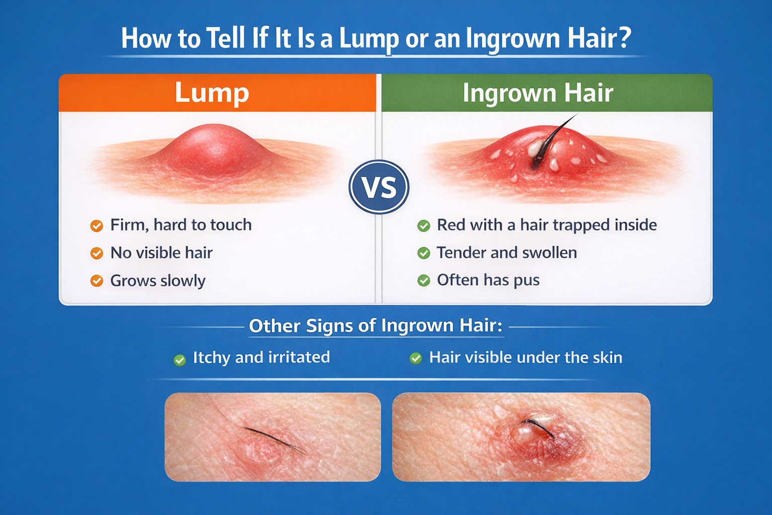 lump vs ingrown hair
