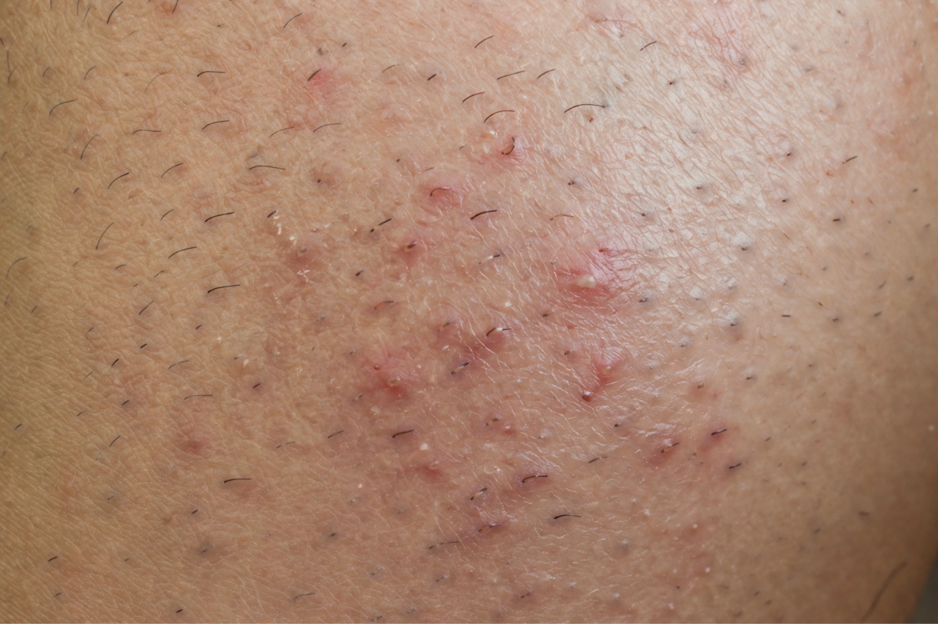 ingrown hair close up