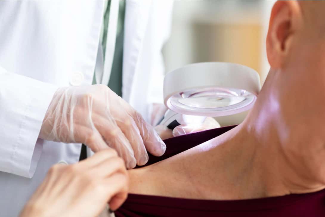 Types of Skin Cancer