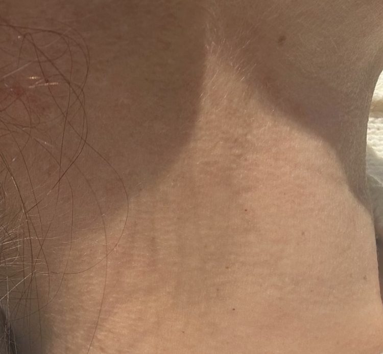 After mole removal on neck