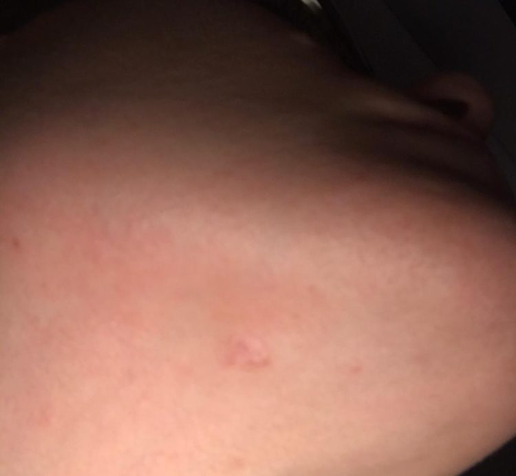 A closer look of a cyst