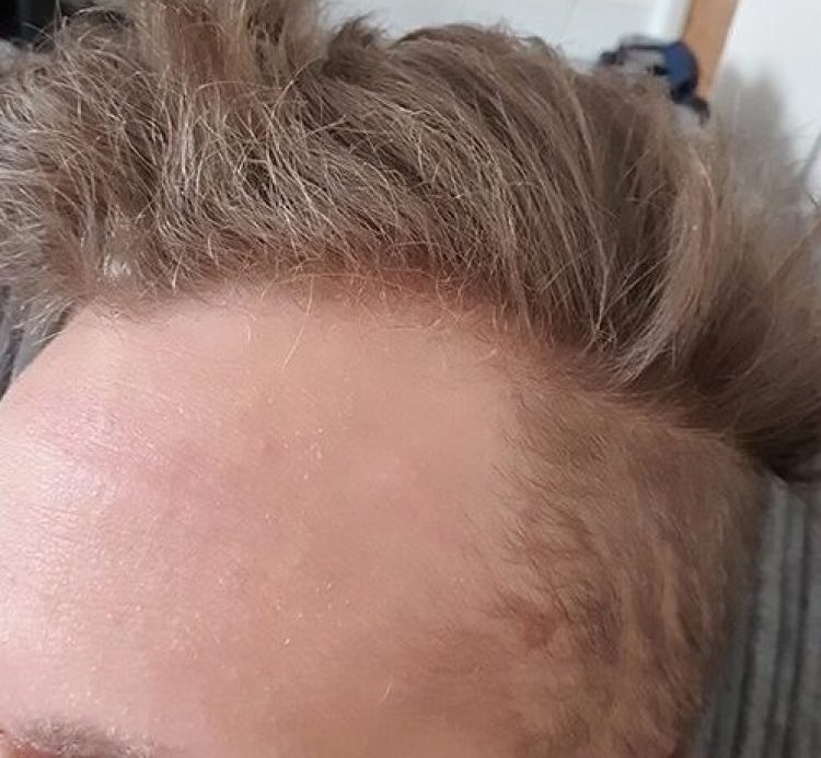 After Forehead Cyst Removal