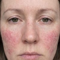 a close up look of Eczema