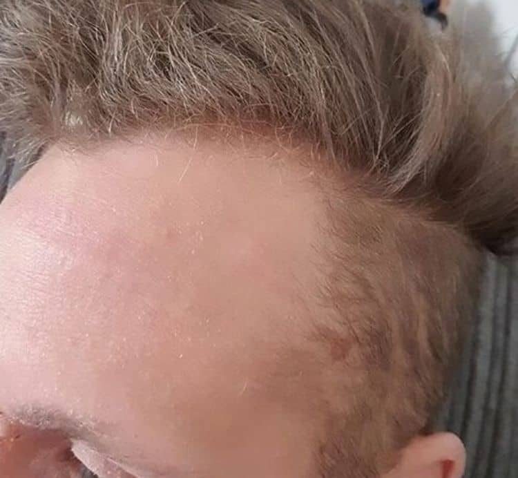 Before and After Cysts